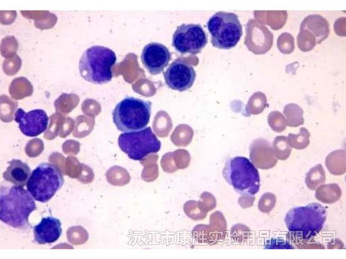 急性髓細胞白血病微分化型（MO)